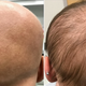 Imagen para el artículo titulado Un efecto secundario en un nuevo fármaco contra la dermatitis devuelve el pelo a una paciente con alopecia
